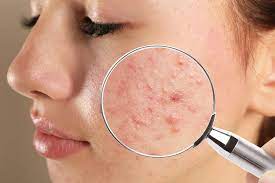 Dermatology Treatments